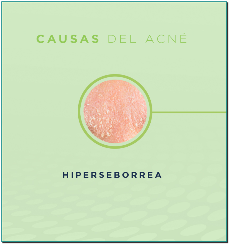 RILASTIL Los factores del acné son cuatro Si sufres el temido acné provocado por la mascarilla (maskné), es posible que combatirlo esté entre tus grandes retos